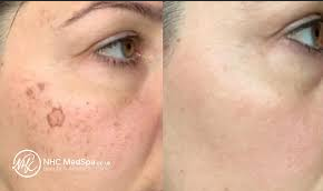 Pigmentation Treatment